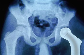 Total Hip Replacement Surgery 